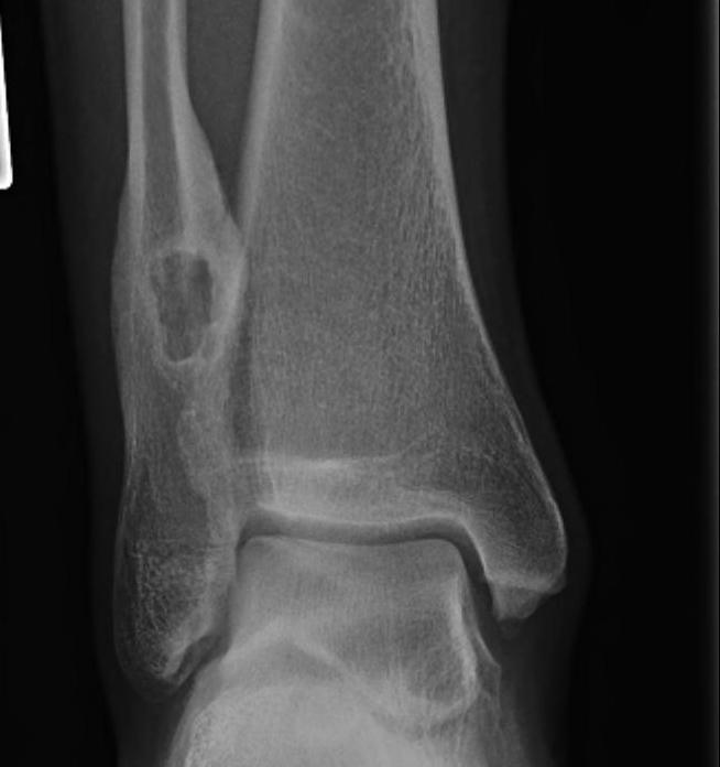 Distal Fibular Lucent Lesion